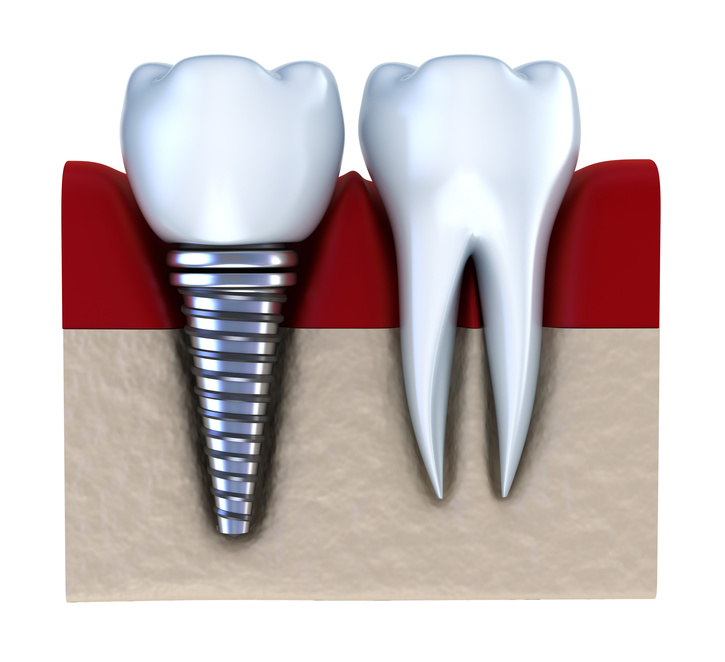 dental implants Keller