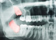 Abscessed Wisdom Teeth