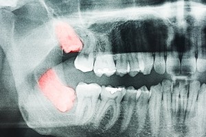 Abscessed Wisdom Teeth