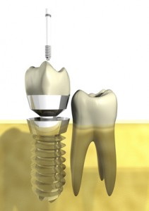 Dental Implant