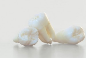 tooth extraction Dallas