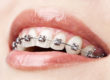 Woman with Braces