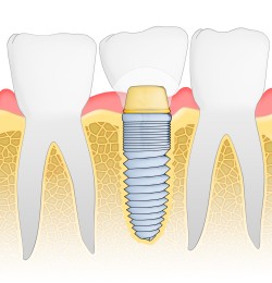 dental implants Keller